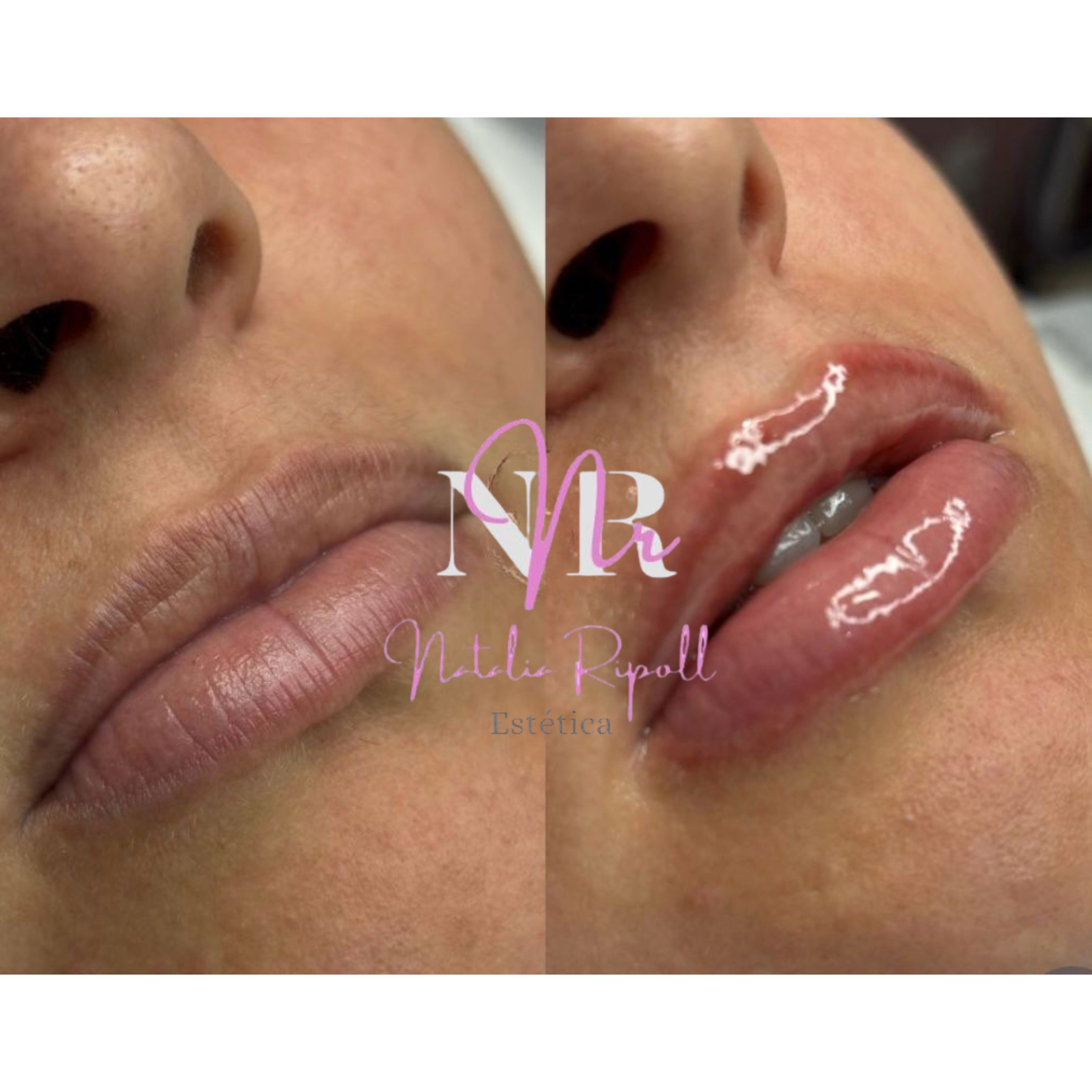 Antes y después de la Revitalización Labial